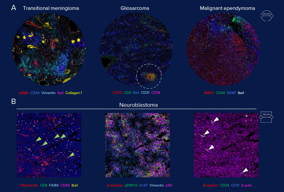 Application of neuro-oncology IMC panel on human and mouse tumors of mixed or non-glial origin. 